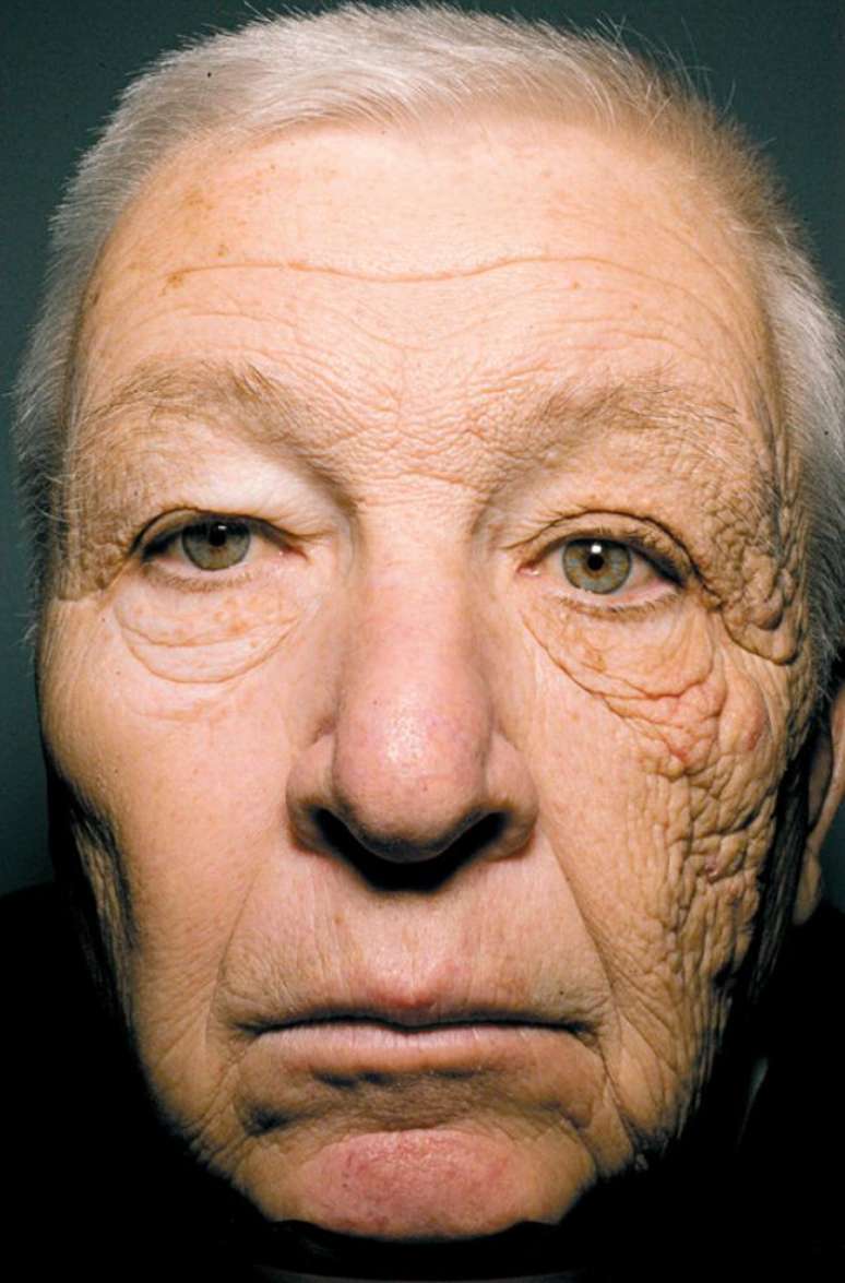 Caminhoneiro tem um lado do rosto "machucado" pela exposi&ccedil;&atilde;o ao sol enquanto dirige